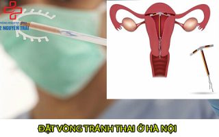 Top 3 địa chỉ đặt vòng tránh thai ở Hà Nội