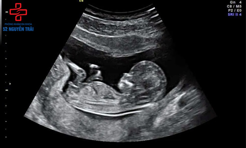 siêu âm thai 14 tuần tuổi
