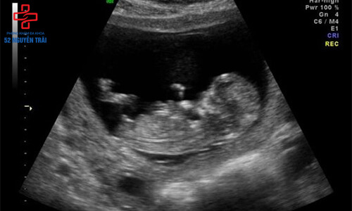 siêu âm giúp xác định giới tính thai nhi