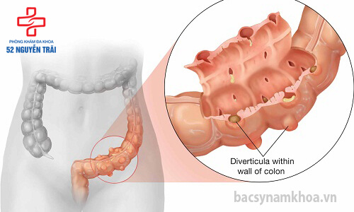 đau bụng dưới bên trái kèm đau lưng là dấu hiệu bệnh viêm vùng chậu