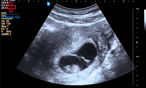 siêu âm thai 8 tuần tuổi