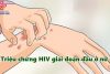 Triệu chứng HIV giai đoạn đầu ở nữ như thế nào?